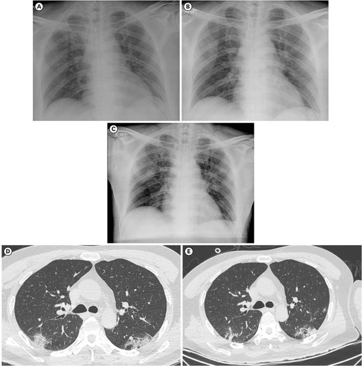 Radiografie a confronto di pazienti affetti da polmoiti virali da Covid-19